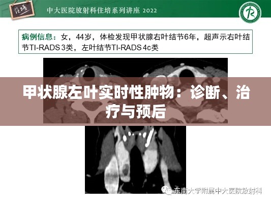 甲状腺左叶实时性肿物：诊断、治疗与预后